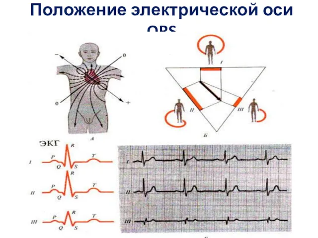 Положение электрической оси QRS
