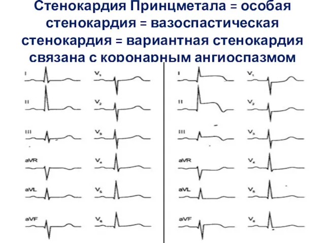 Стенокардия Принцметала = особая стенокардия = вазоспастическая стенокардия = вариантная стенокардия связана с коронарным ангиоспазмом