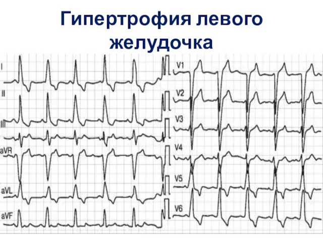 Гипертрофия левого желудочка