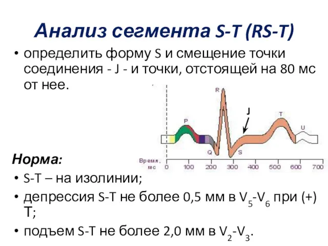 Анализ сегмента S-T (RS-T) определить форму S и смещение точки