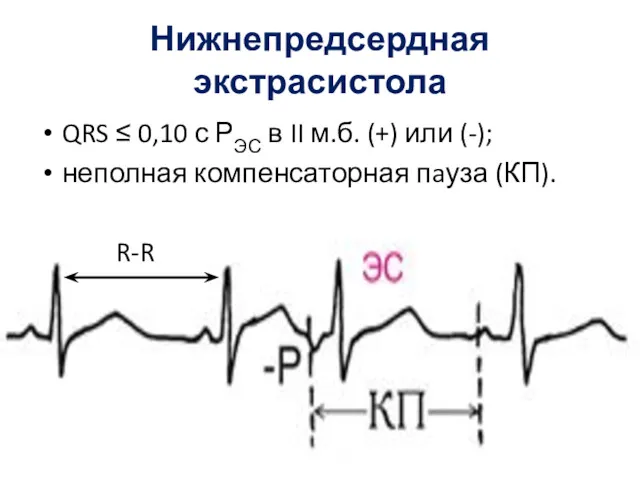 Нижнепредсердная экстрасистола QRS ≤ 0,10 с РЭС в II м.б.