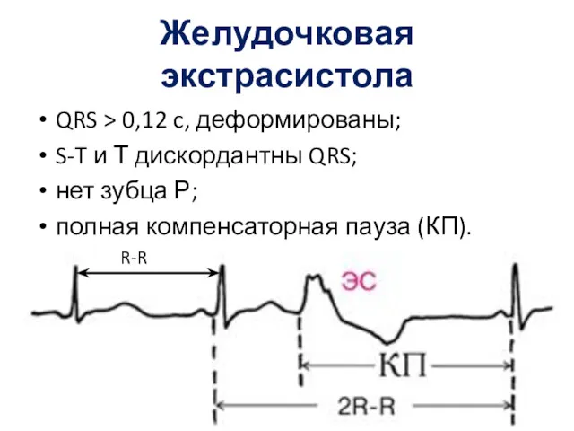 Желудочковая экстрасистола QRS > 0,12 c, деформированы; S-T и Т