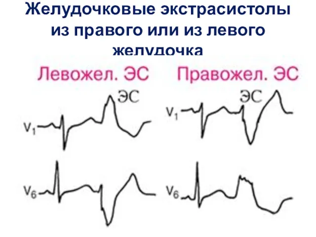 Желудочковые экстрасистолы из правого или из левого желудочка