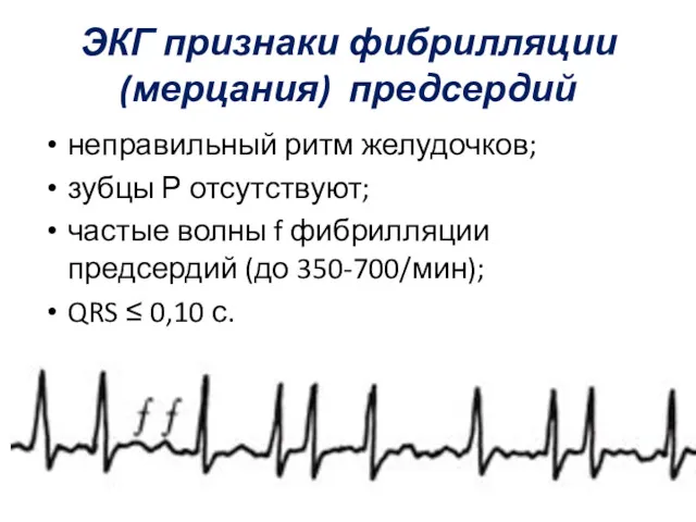ЭКГ признаки фибрилляции (мерцания) предсердий неправильный ритм желудочков; зубцы Р