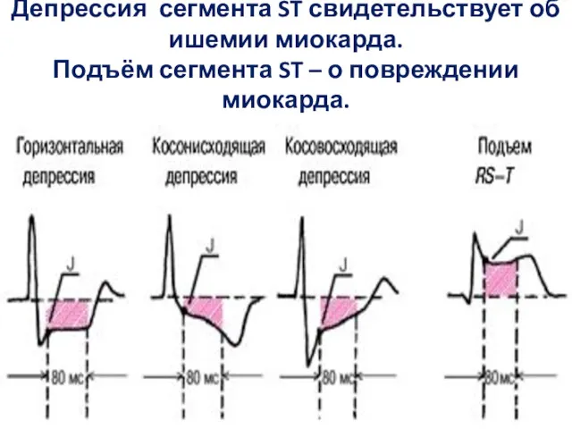 Депрессия сегмента ST свидетельствует об ишемии миокарда. Подъём сегмента ST – о повреждении миокарда.