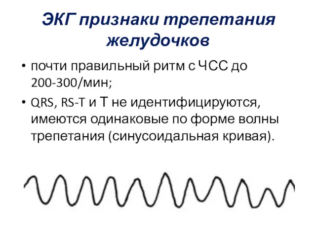 ЭКГ признаки трепетания желудочков почти правильный ритм с ЧСС до