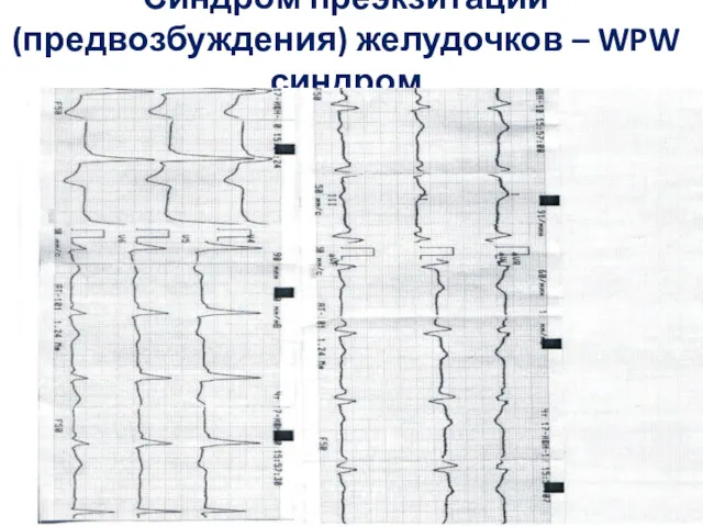 Синдром преэкзитации (предвозбуждения) желудочков – WPW синдром