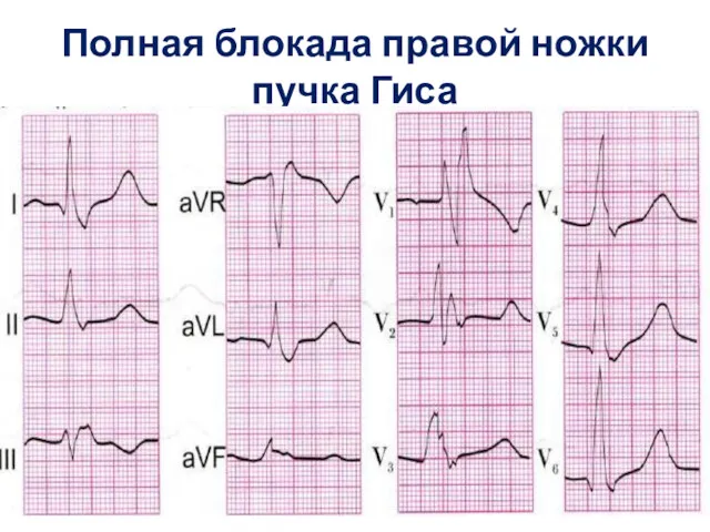 Полная блокада правой ножки пучка Гиса