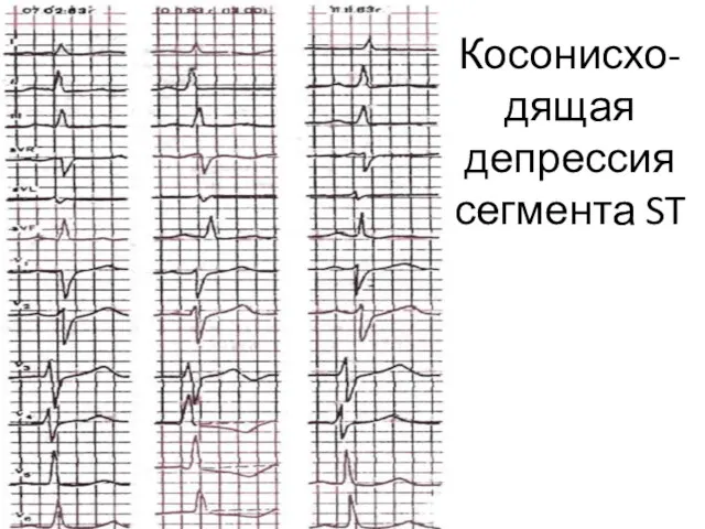 Косонисхо-дящая депрессия сегмента ST