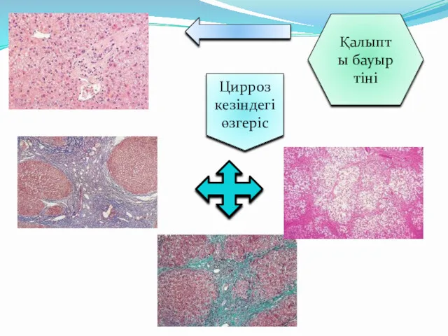 Қалыпты бауыр тіні Цирроз кезіндегі өзгеріс