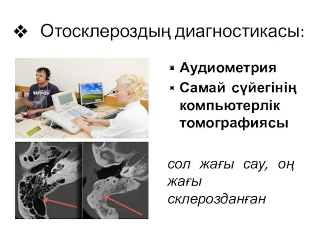 Отосклероздың диагностикасы: Аудиометрия Самай сүйегінің компьютерлік томографиясы сол жағы сау, оң жағы склерозданған