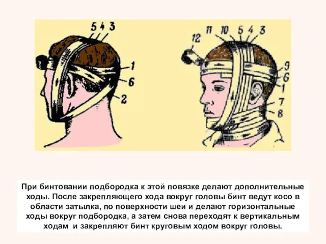 При бинтовании подбородка к этой повязке делают дополнительные ходы. После