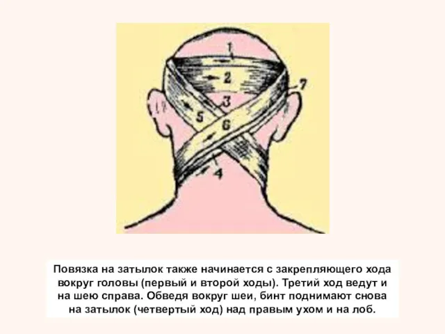 Повязка на затылок также начинается с закрепляющего хода вокруг головы