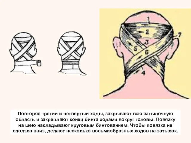 Повторяя третий и четвертый ходы, закрывают всю затылочную область и