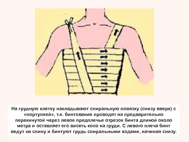 На грудную клетку накладывают спиральную повязку (снизу вверх) с «портупеей»,