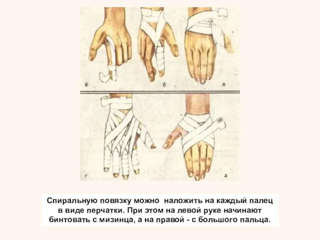 Спиральную повязку можно наложить на каждый палец в виде перчатки.