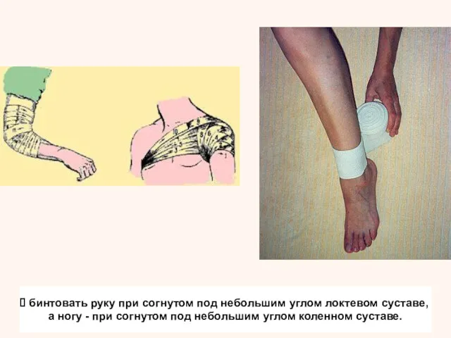 бинтовать руку при согнутом под небольшим углом локтевом суставе, а