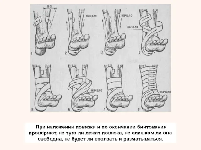 При наложении повязки и по окончании бинтования проверяют, не туго