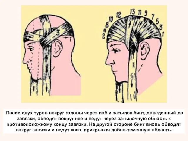 После двух туров вокруг головы через лоб и затылок бинт,