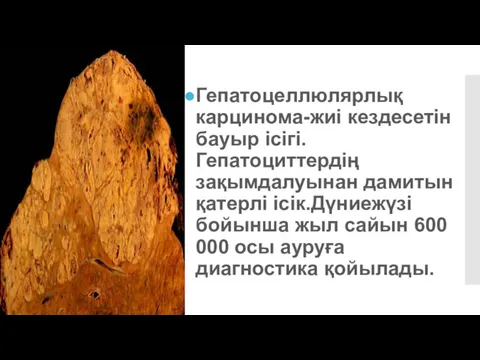 Гепатоцеллюлярлық карцинома-жиі кездесетін бауыр ісігі.Гепатоциттердің зақымдалуынан дамитын қатерлі ісік.Дүниежүзі бойынша