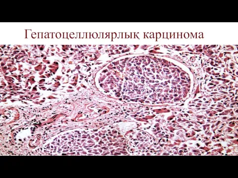 Гепатоцеллюлярлық карцинома