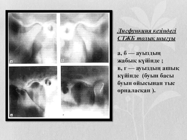 Дисфункция кезіндегі СТЖБ толық шығуы а, б — ауыздың жабық