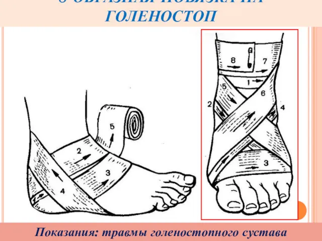 8-ОБРАЗНАЯ ПОВЯЗКА НА ГОЛЕНОСТОП Показания: травмы голеностопного сустава