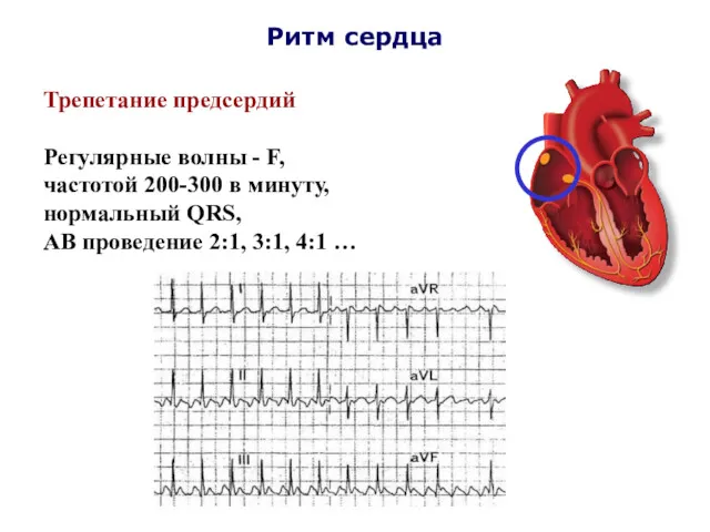 Ритм сердца Трепетание предсердий Регулярные волны - F, частотой 200-300