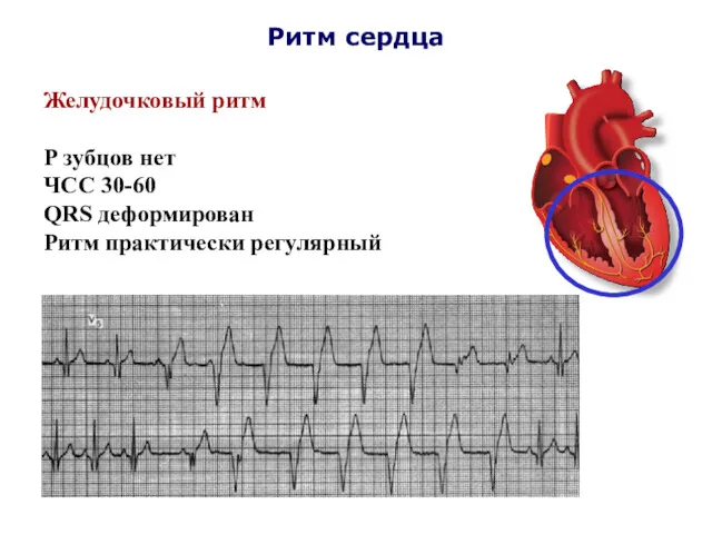 Ритм сердца Желудочковый ритм Р зубцов нет ЧСС 30-60 QRS деформирован Ритм практически регулярный