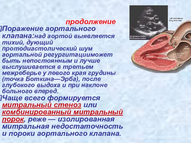 продолжение Поражение аортального клапана:над аортой выявляется тихий, дующий протодиастолический шум