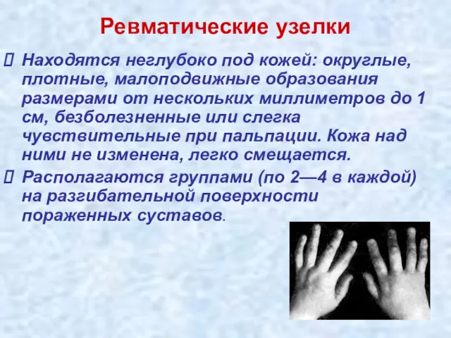 Ревматические узелки Находятся неглубоко под кожей: округлые, плотные, малоподвижные образования