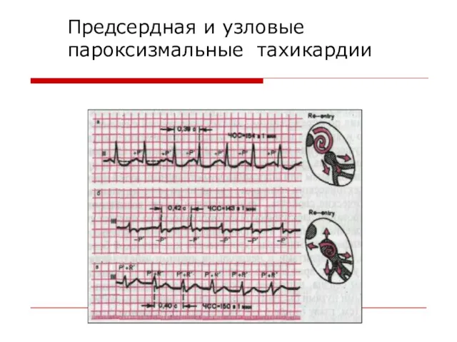 Предсердная и узловые пароксизмальные тахикардии