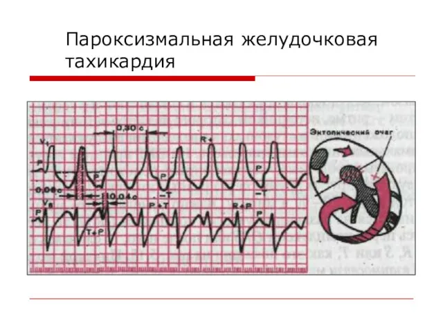 Пароксизмальная желудочковая тахикардия