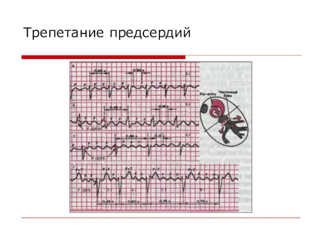 Трепетание предсердий