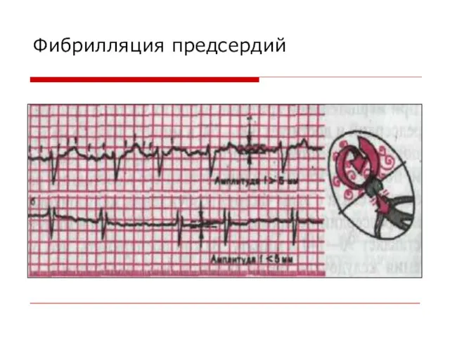 Фибрилляция предсердий