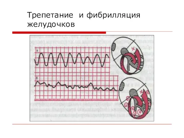 Трепетание и фибрилляция желудочков