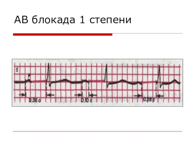 АВ блокада 1 степени