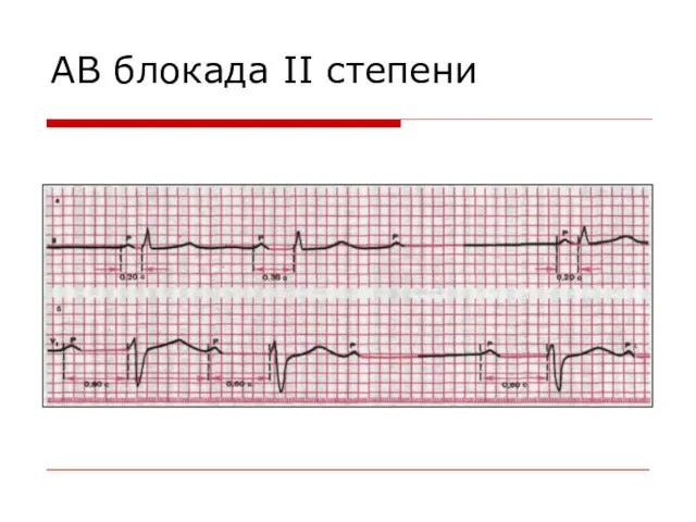 АВ блокада II степени