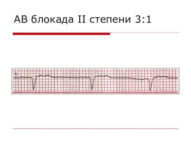 АВ блокада II степени 3:1