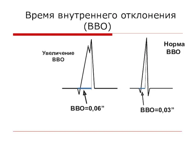 Время внутреннего отклонения (ВВО) Норма ВВО Увеличение ВВО ВВО=0,06” ВВО=0,03”