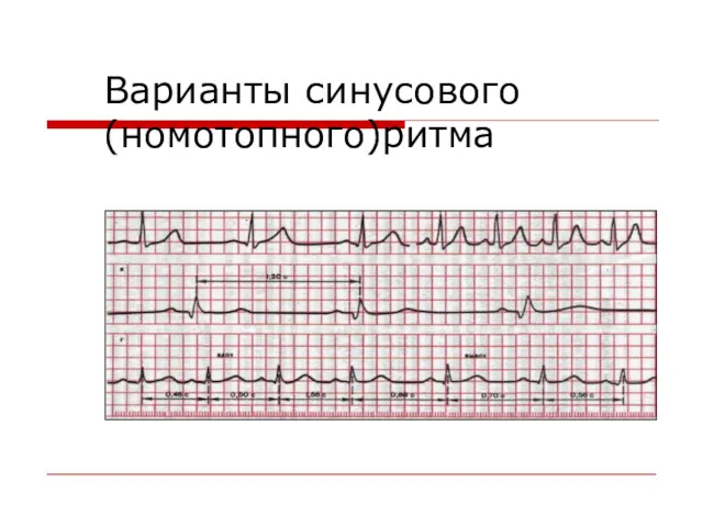 Варианты синусового (номотопного)ритма