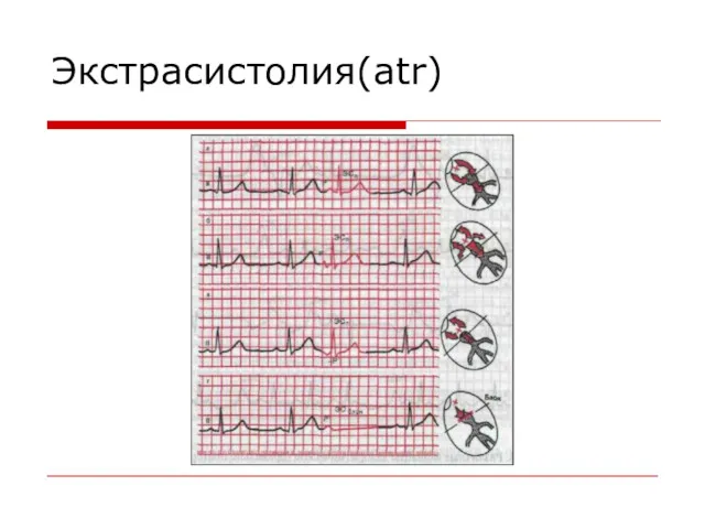 Экстрасистолия(atr)