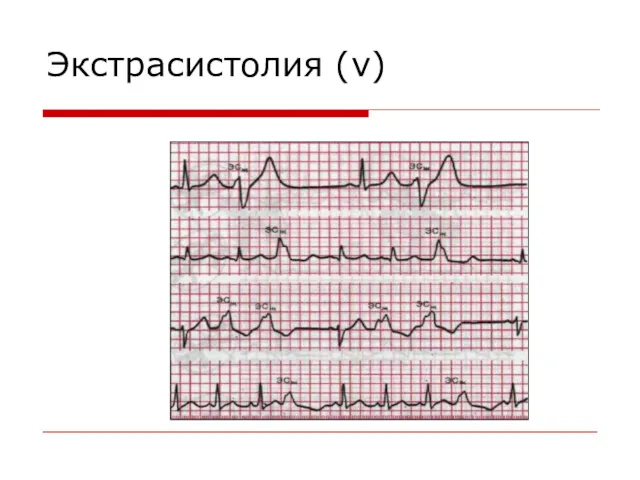 Экстрасистолия (v)