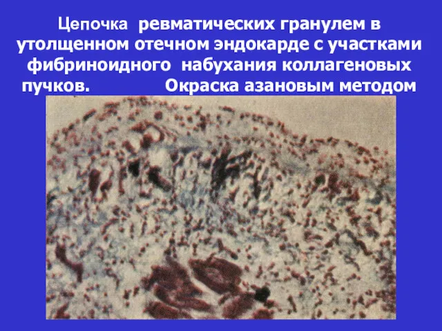 Цепочка ревматических гранулем в утолщенном отечном эндокарде с участками фибриноидного