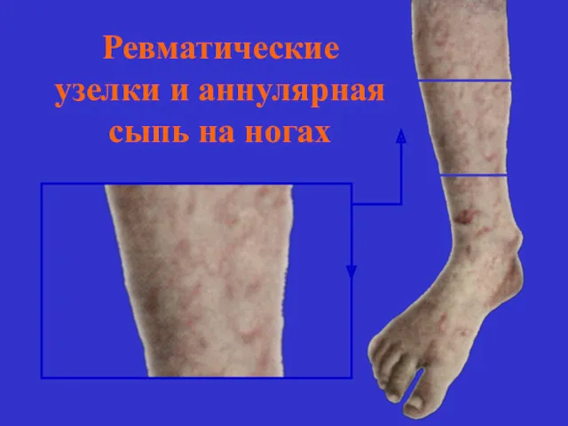 Ревматические узелки и аннулярная сыпь на ногах