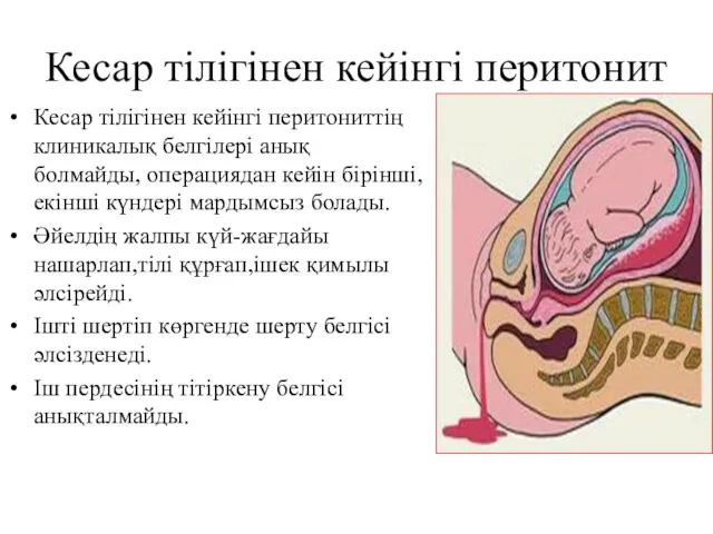 Кесар тілігінен кейінгі перитонит Кесар тілігінен кейінгі перитониттің клиникалық белгілері