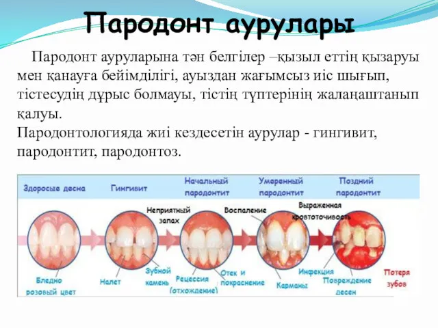 Пародонт аурулары Пародонт ауруларына тән белгілер –қызыл еттің қызаруы мен қанауға бейімділігі, ауыздан