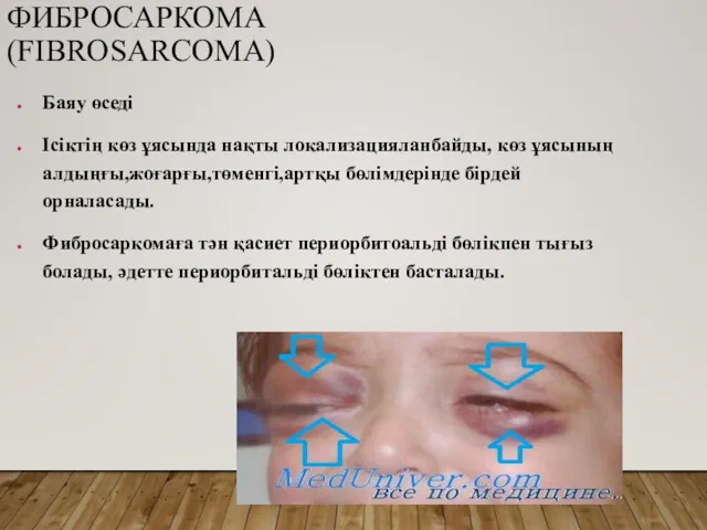 ФИБРОСАРКОМА (FIBROSARCOMA) Баяу өседі Ісіктің көз ұясында нақты локализацияланбайды, көз