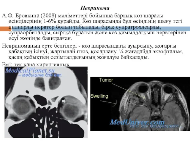 Невринома А.Ф. Бровкина (2008) мәліметтері бойынша барлық көз шарасы өсінділерінің