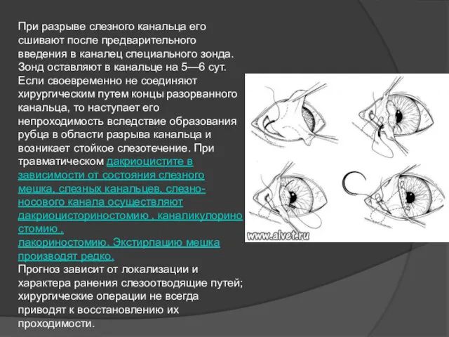 При разрыве слезного канальца его сшивают после предварительного введения в